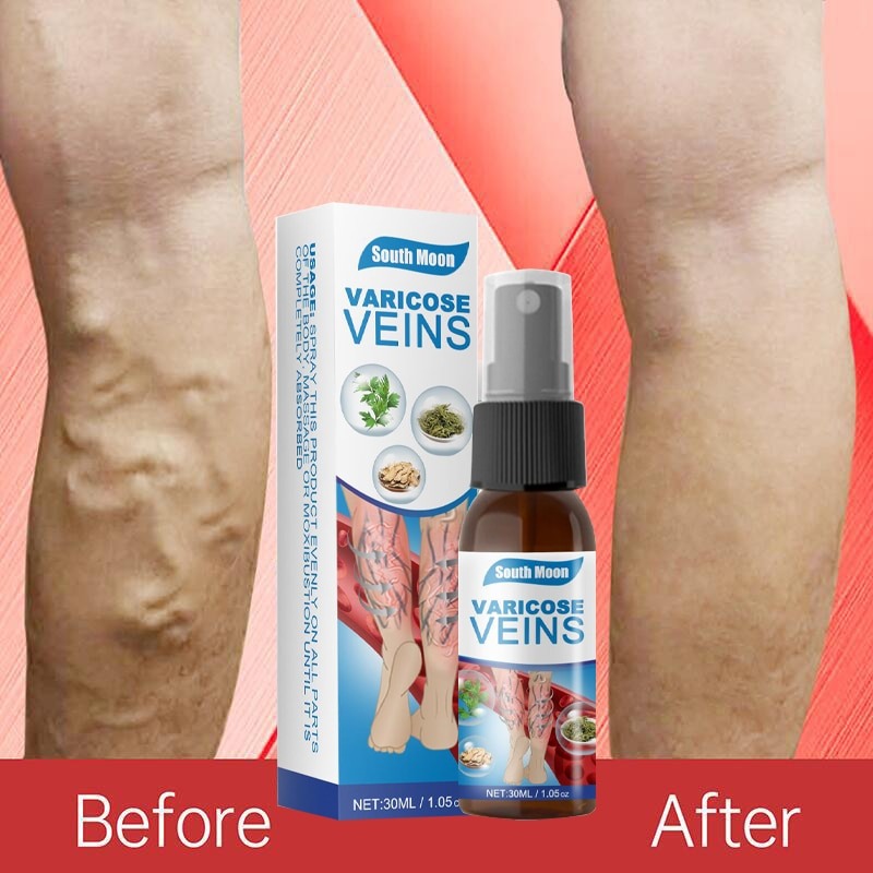 Varicose Vein Relief Spray